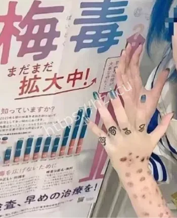 日本梅毒感染